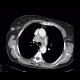Lung tumour, adrenal metastasis, mediastinal lymphadenopathy: CT - Computed tomography